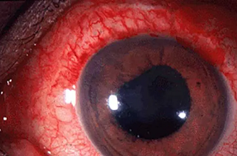 UVEITIS